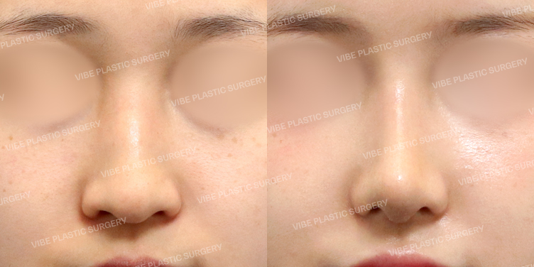#콧대 #코끝 #자가늑 #복코 #긴코 #매부리 #절골 #비순각교정