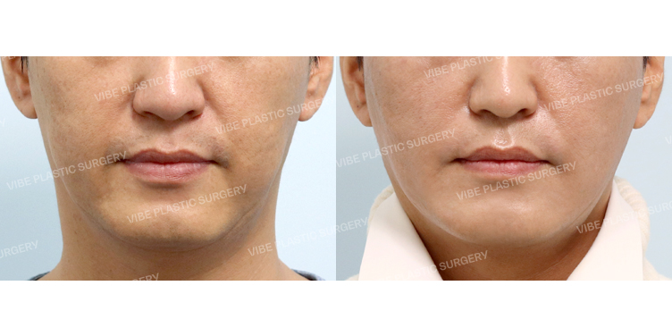 #심부볼지방제거 #실리프팅 #래디어스