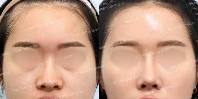 #지방이식(앞볼,눈밑) #콧대 #코끝 #복코 #긴코 #휜코 #절골 #이물질제거