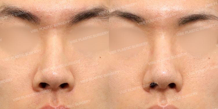 #무보형물코성형 #매부리 #콧볼축소(내측절개) #복코 #비공교정