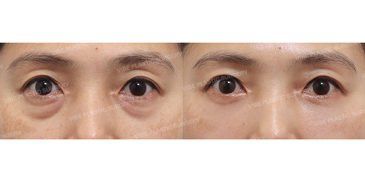 #눈밑지방재배치 #PRP