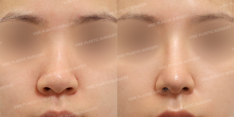 #콧대 #코끝 #매부리 #복코 #콧볼축소