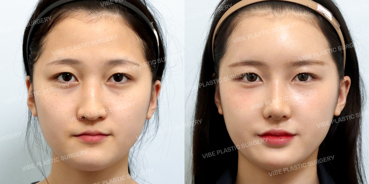 #콧대 #코끝 #자가늑 #복코 #긴코 #매부리 #절골 #비순각교정 #풀페이스지방이식(이마,관자,눈밑) #입술필러
