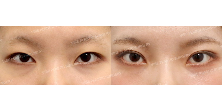 #자연유착쌍꺼풀