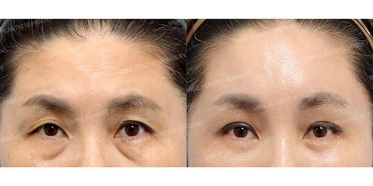 #내시경이마거상 #하안검 #중안면부거상 #자연유착쌍꺼풀