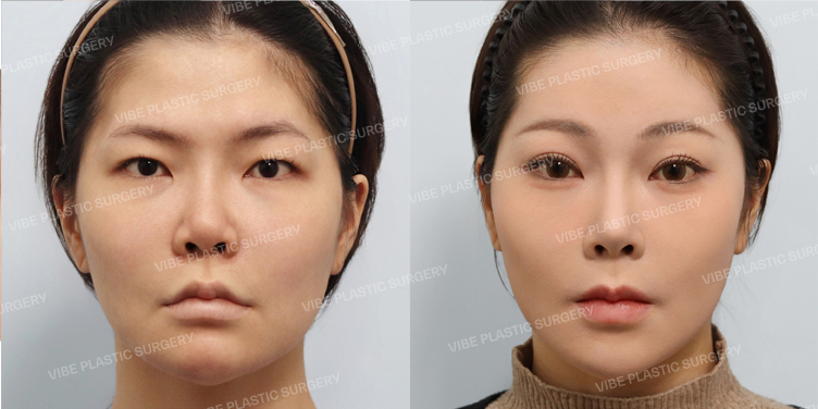 #코재수술 #자가늑 #짧은코 #복코 #내시경이마거상술 #절개쌍꺼풀