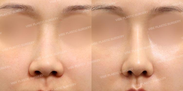 #콧대 #코끝 #복코 #긴코 #매부리코 #비순각교정