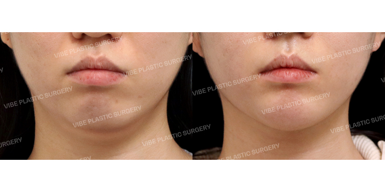 #초음파지방흡입(이중턱,턱라인,팔자위) #실리프팅 #팔자필러