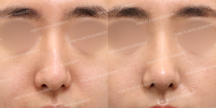 #무보형물 #코끝 #비중격 #긴코 #복코