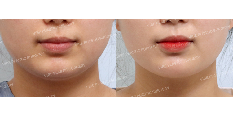 #초음파지방흡입(이중턱,턱라인) #슈링크 #사각턱보톡스