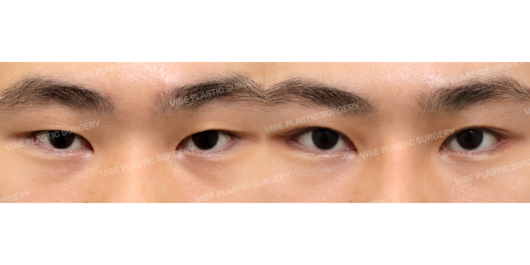 #비절개눈매교정 #뒤트임 #밑트임