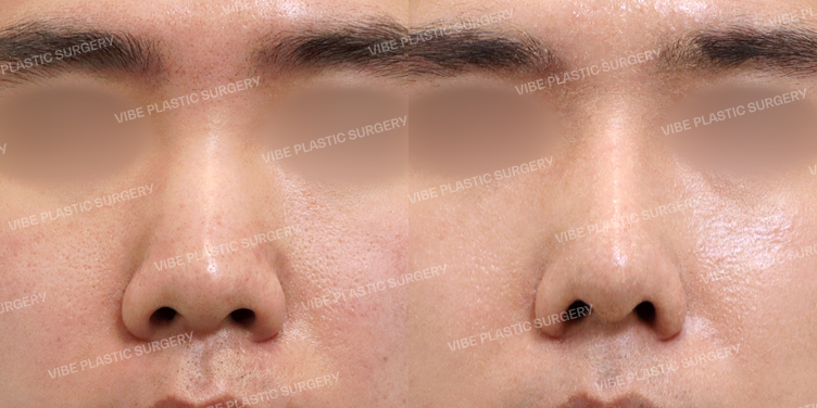 #남자코 #콧대 #코끝 #절골 #복코 #기증늑 #비중격 #기능코