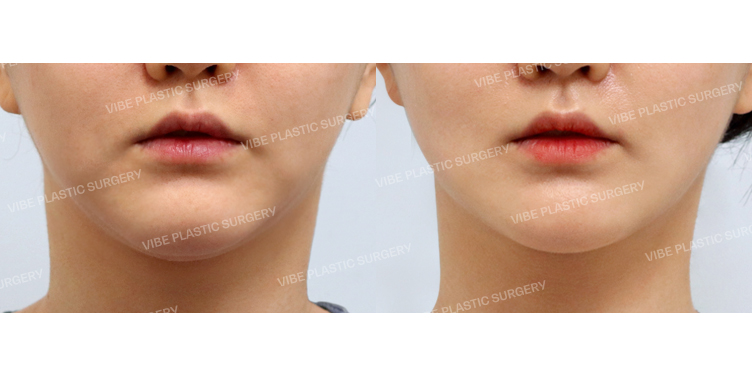 #초음파지방흡입(이중턱,턱라인) #목거상(이중턱근육묶기)