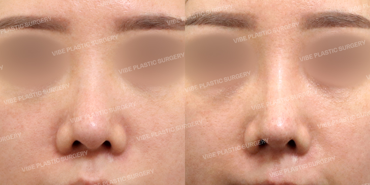 #코재수술 #비중격 #기증늑 #비주교정 #복코