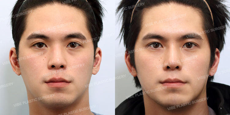 #비절개눈매교정 #콧대 #코끝 #매부리 #짧은코 #비중격