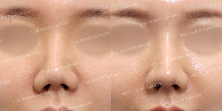 #코재수술 #복코 #비순각교정