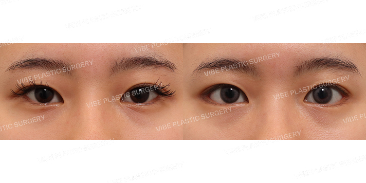 #뒤트임 #밑트임