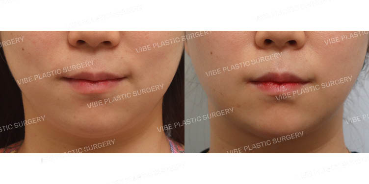 #이중턱&턱라인 지방흡입