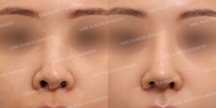 #복코 #비공교정 #필러녹이기