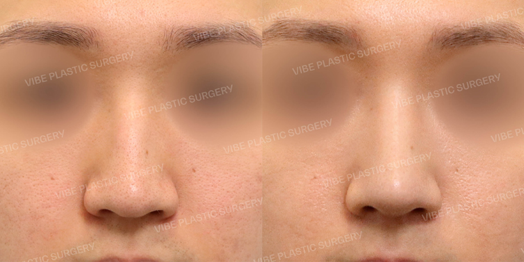 #무보형물 #매부리코 #화살코 #긴코 #절골 #비순각교정