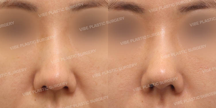 #무보형물 #매부리코 #긴코