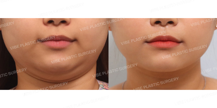 #초음파지방흡입(이중턱,턱라인)