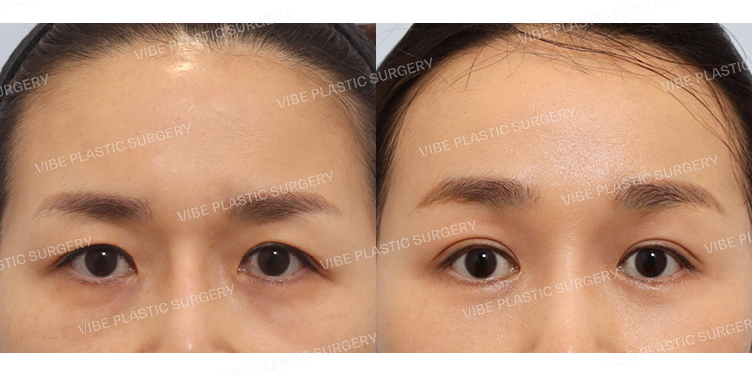 #자연유착 #하안검 #내시경이마거상