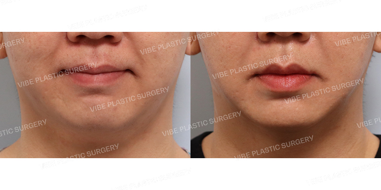 #리포사운드(이중턱,팔자위) #실리프팅(이중턱,팔자)