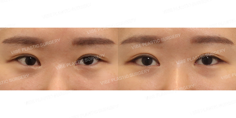 #뒤트임 #밑트임