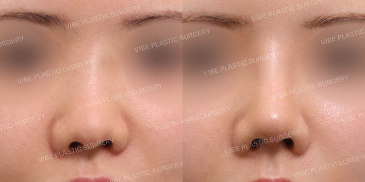 #복코 #짧은코 #휜코 #콧대 #필러녹이기 #이물질제거