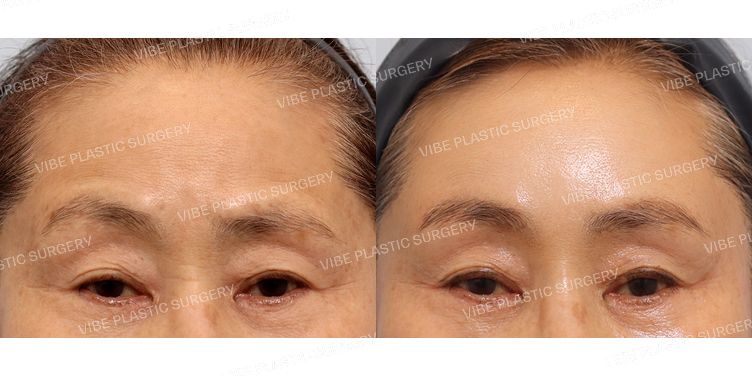 #내시경이마거상