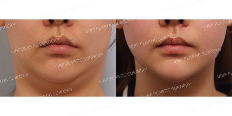 #초음파지방흡입(이중턱,턱라인)