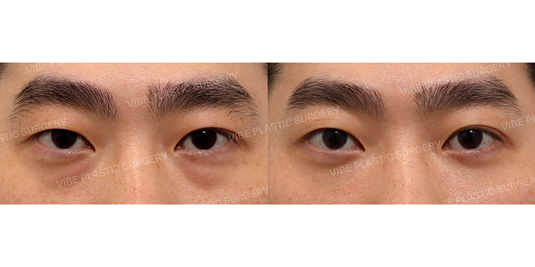 #눈밑지방재배치 #PRP주사