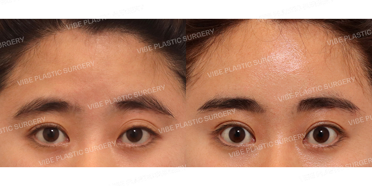 #절개눈매교정(재수술) #내시경이마거상