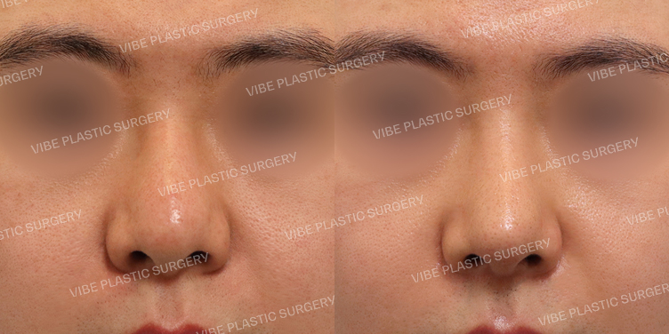 #무보형물 #매부리코 #복코