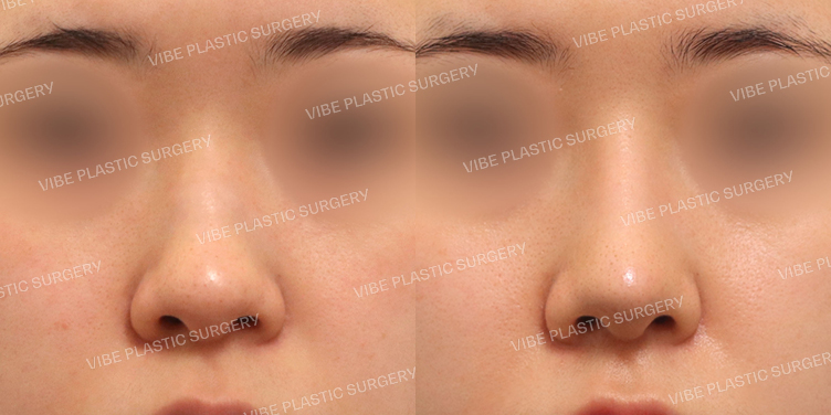 #매부리코 #복코