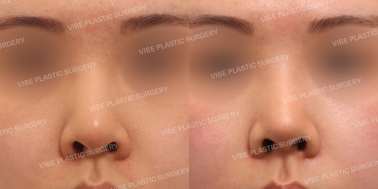 #무보형물 #낮은코 #복코