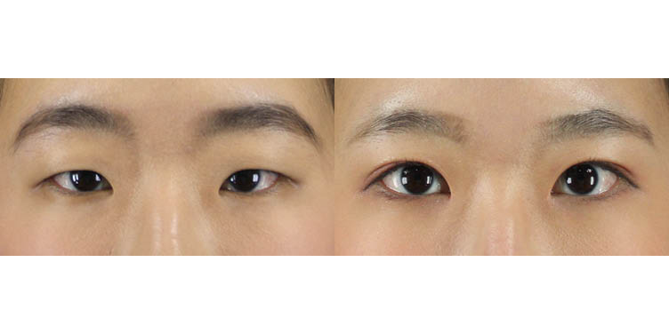 #부분절개눈매교정 #앞트임