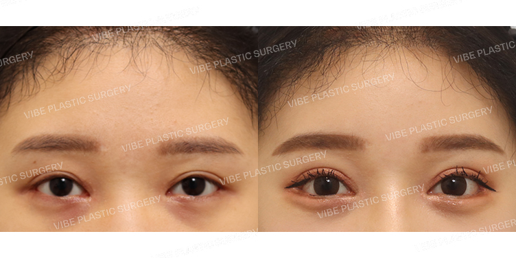 #절개쌍꺼풀(재수술) #뒤트임 #밑트임 #내시경이마거상