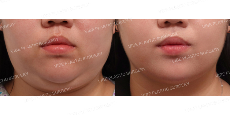 #초음파지방흡입(이중턱,턱라인)