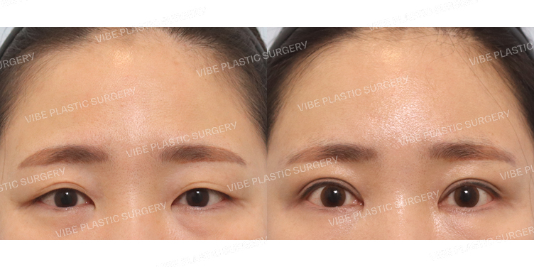 #부분절개쌍꺼풀 #내시경이마거상