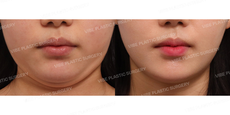 #초음파지방흡입(이중턱,턱라인) #심부볼지방제거