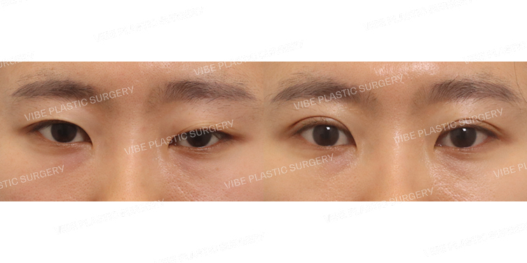 #비절개눈매교정