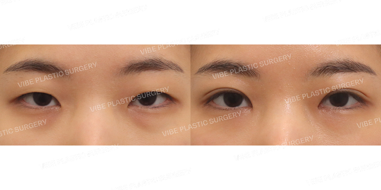 #비절개눈매교정