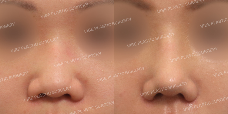 #낮은코 #복코 #콧볼축소