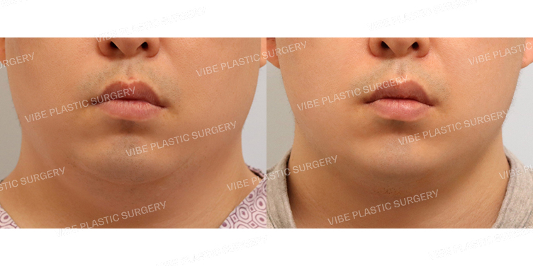 #초음파지방흡입(이중턱,턱라인) #실리프팅