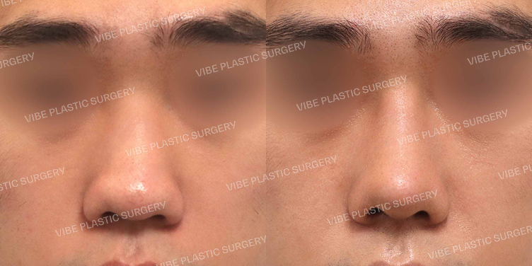 #낮은코 #매부리코 #복코