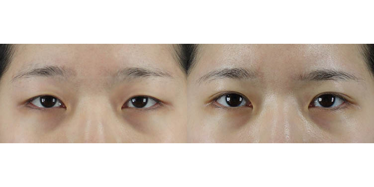 #부분절개눈매교정