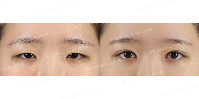 #비절개눈매교정