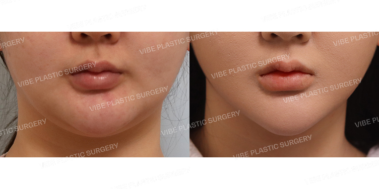 #실루엣리프팅(심술보) #초음파지방흡입(이중턱,턱라인,앞볼)